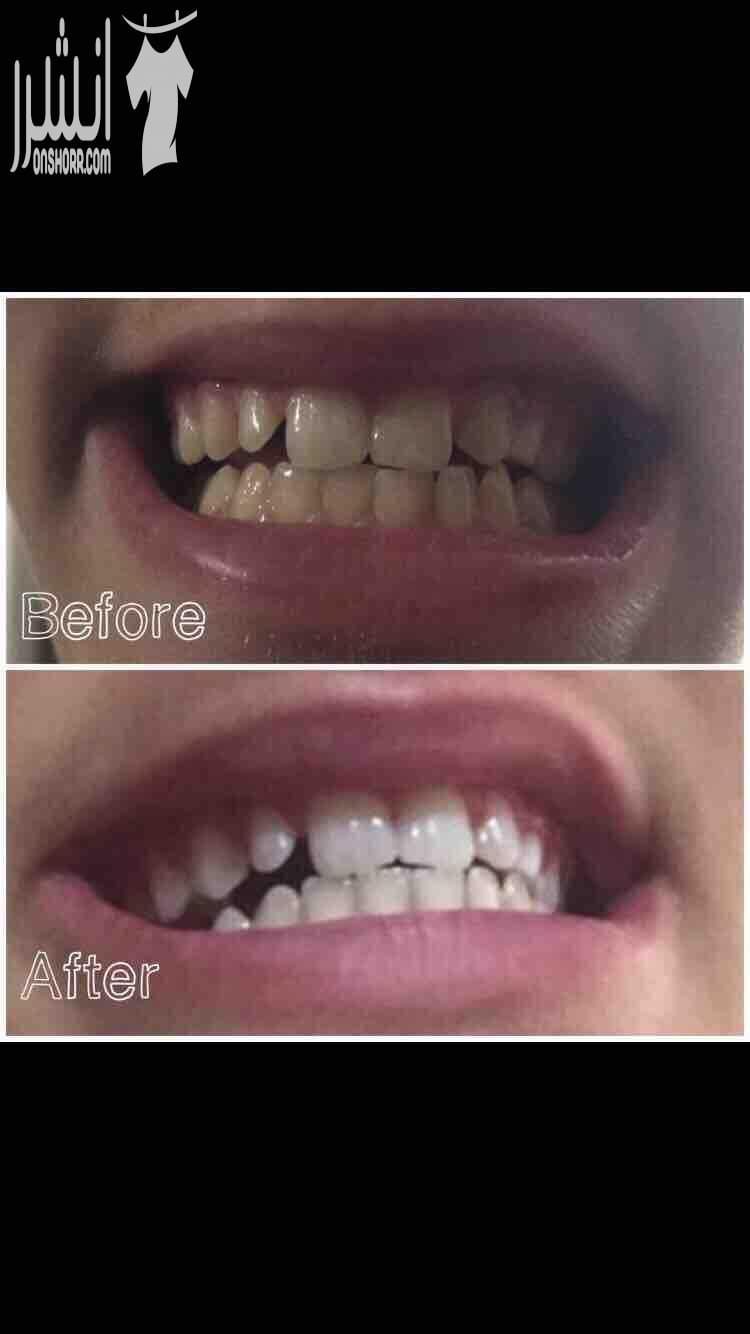 Crest 3D White Professional Effects Whitestrips لصقات كريست لتبييض الاسنان..أسرع و أفضل منتج لتبييض الأسنان و أرخص من عمليات تبييض الأسنان بالليزر التي تكلف الكثير و لا تخلو من أثارها السلبيه وأهمها...