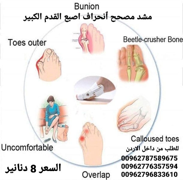 جهاز علاج انحراف إصبع القدم الكبير بدون جراحة