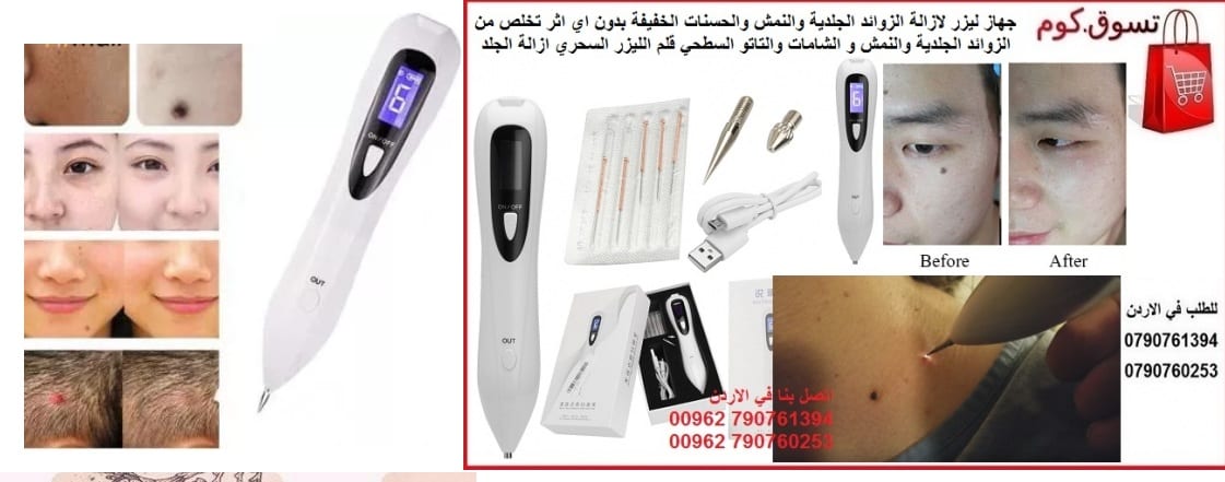 جهاز طبي ازالة زوائد الجلد و نمش الوجه يمكن علاج النمش وتجديد الجلد بواسطة استخدام